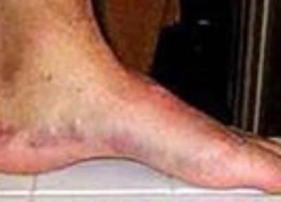 لکه های خون در زیر پوست