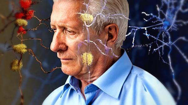 درمانی برای بیماران آلزایمری با سالم سازی سلول های آسیب دیده
